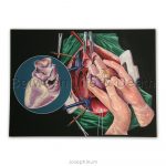 Drawing Metzenbauer: Heart transplant